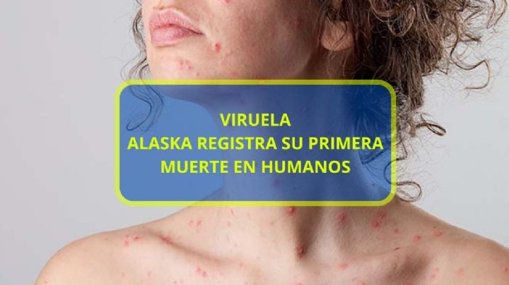 Enfermedad registra su primera muerte en humanos, la Viruela de Alaska, ¿qué es?